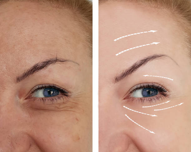 Sculptra before and after, collagen restoration