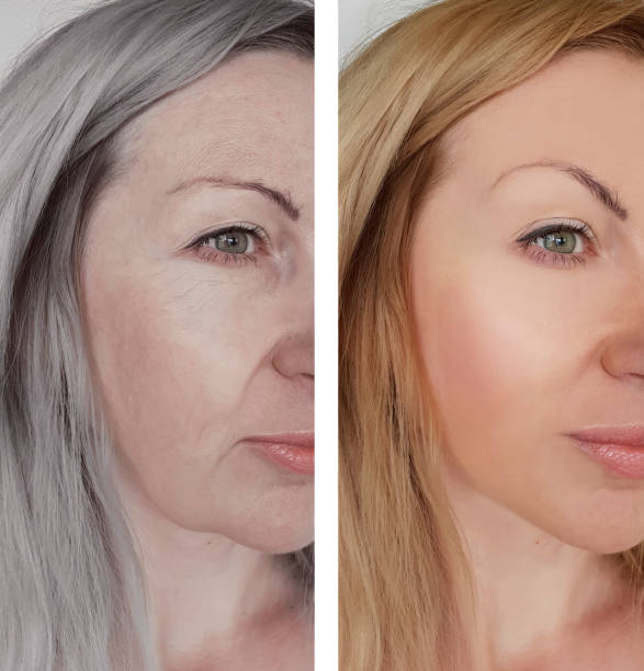 Sculptra before and after, natural rejuvenation