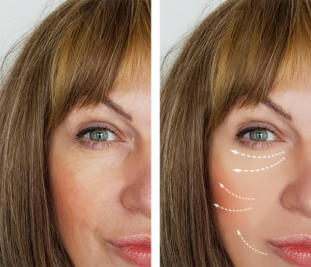 Sculptra before and after, natural rejuvenation