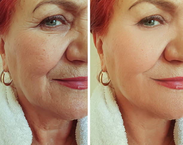 Sculptra before and after, improved skin firmness