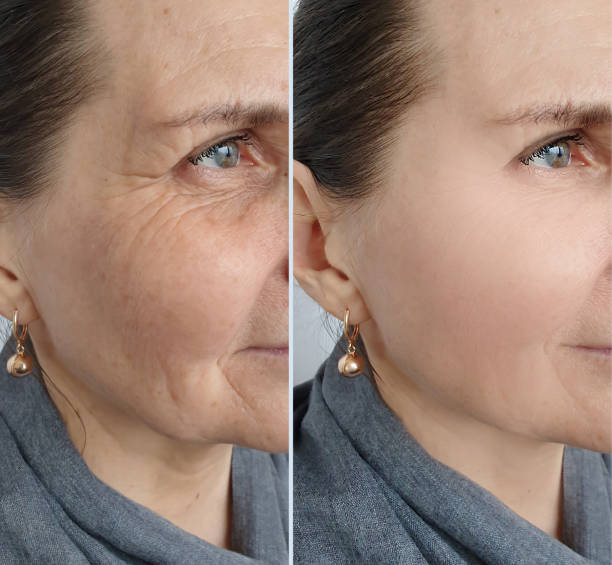 Sculptra before and after, real patient result