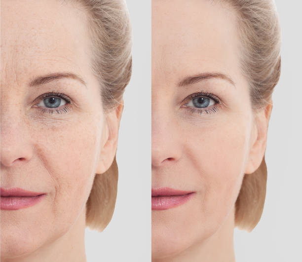 Sculptra before and after, skin firmness restored