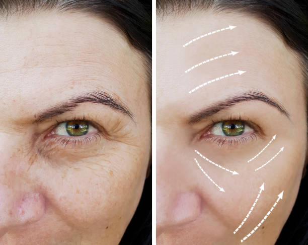 Sculptra before and after, subtle lift and glow