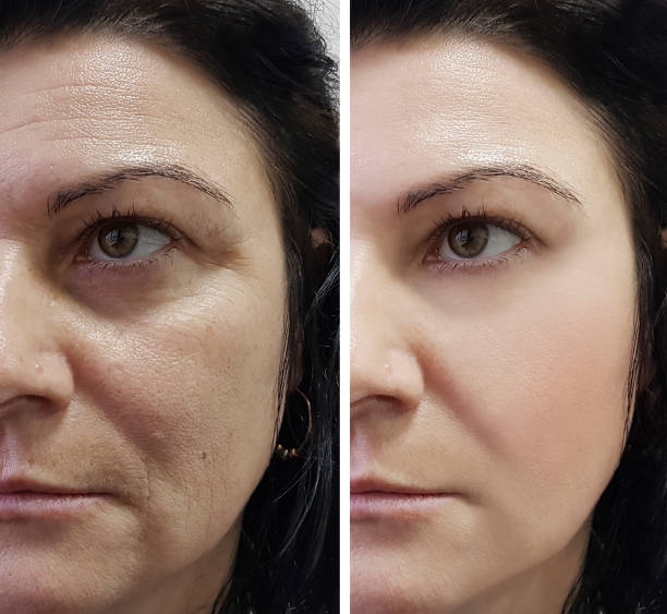 Sculptra before and after, gradual natural results